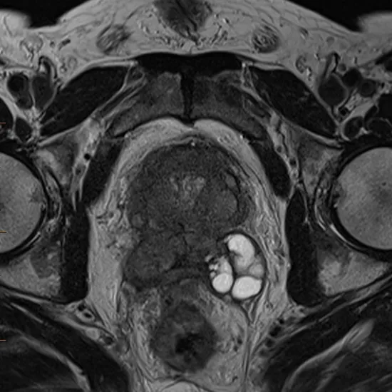 MRI Perfusion Prostate